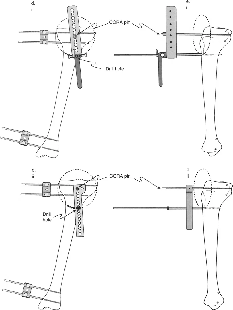تصحيح تشوهات الساق المعقدة: تقنيات تثبيت العظم المتقدمة ومبادئ بالي مع الأستاذ الدكتور محمد هطيف