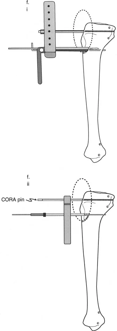 صورة توضيحية لـ تصحيح تشوهات الساق المعقدة: تقنيات تثبيت العظم المتقدمة ومبادئ بالي مع الأستاذ الدكتور محمد هطيف