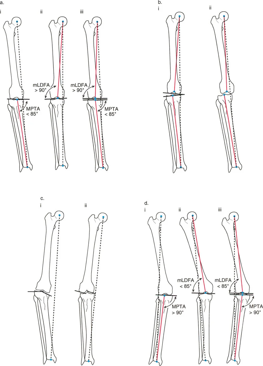 صورة توضيحية لـ فهم محاذاة الأطراف السفلية الطبيعية: دليلك الشامل لصحة المفاصل والحركة السليمة
