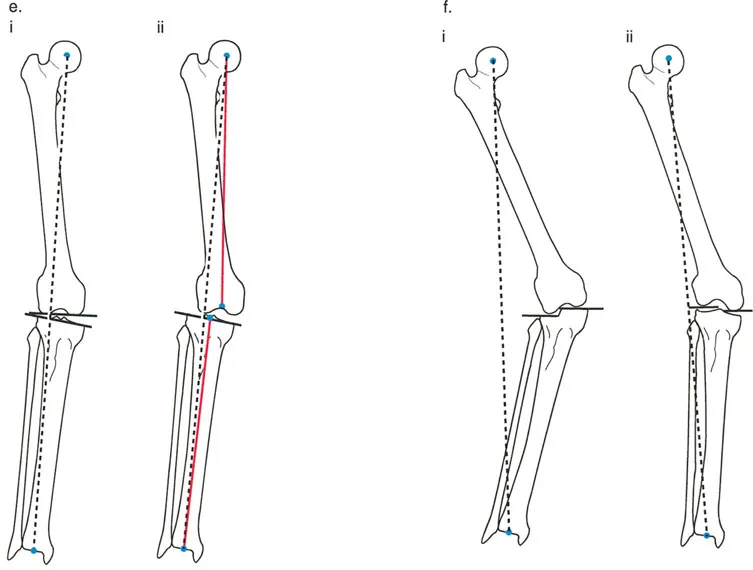 فهم محاذاة الأطراف السفلية الطبيعية: دليلك الشامل لصحة المفاصل والحركة السليمة