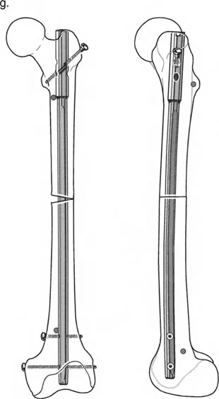 صورة توضيحية لـ تصحيح تشوهات العظام المتقدمة: مبادئ بالي وتقنيات الأستاذ الدكتور محمد هطيف في صنعاء