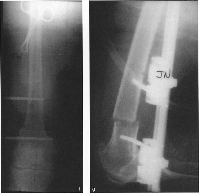 صورة بالأشعة السينية تظهر فشل التثبيت أحادي المسمار في الحفاظ على المحاذاة في المستوى السهمي