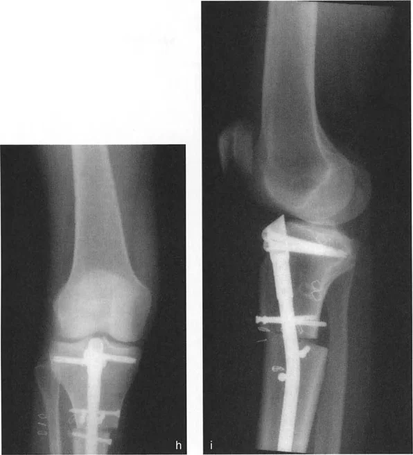 تصحيح تشوهات العظام المتقدمة: مبادئ بالي وتقنيات الأستاذ الدكتور محمد هطيف في صنعاء