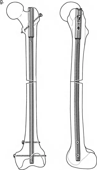 توضيح طبي: تثبيت المسمار الداخلي بمساعدة المثبت الخارجي (FAN): الحل المتقدم لتصحيح تشوهات العظام