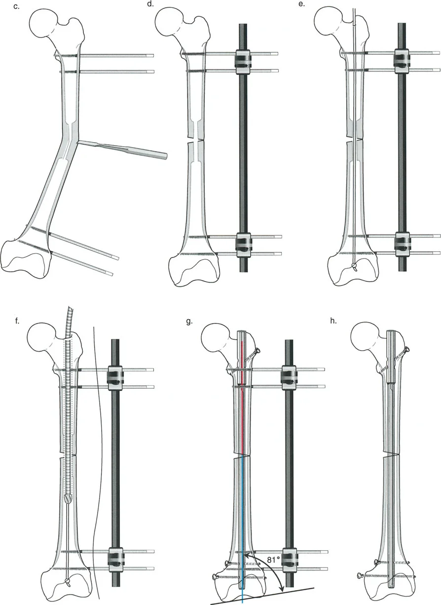 توضيح طبي: تصحيح تشوهات العظام وتطويلها: خبرة الأستاذ الدكتور محمد هطيف في صنعاء
