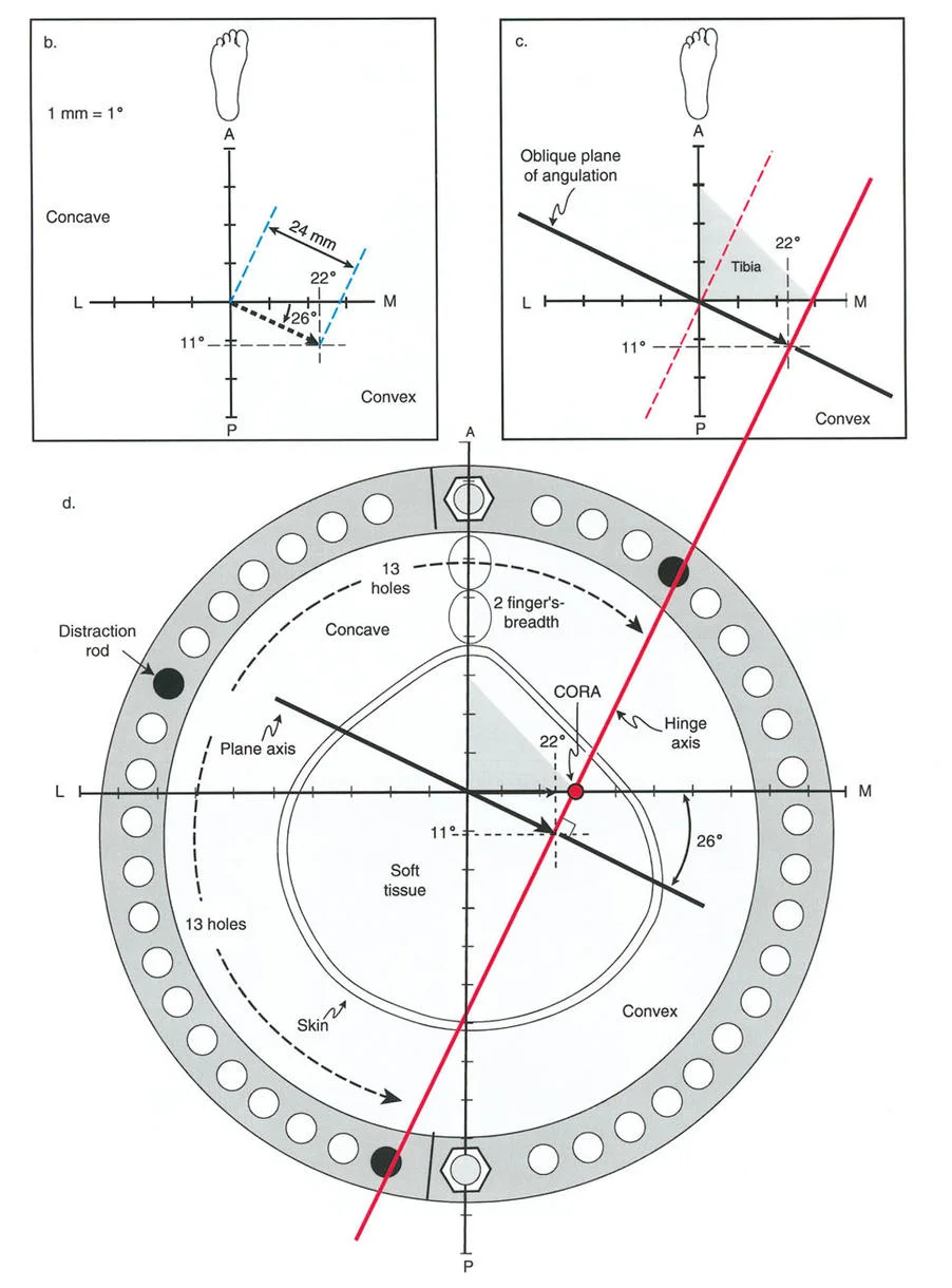 توضيح طبي: تصحيح تشوهات العظام وتطويلها: خبرة الأستاذ الدكتور محمد هطيف في صنعاء