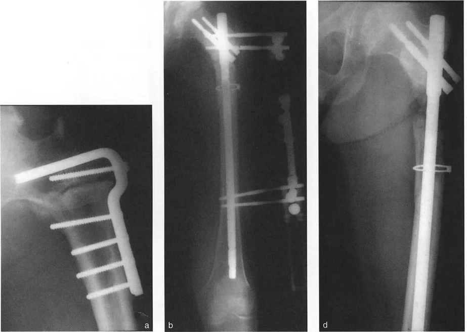 توضيح طبي: تصحيح تشوهات العظام وتطويلها: خبرة الأستاذ الدكتور محمد هطيف في صنعاء