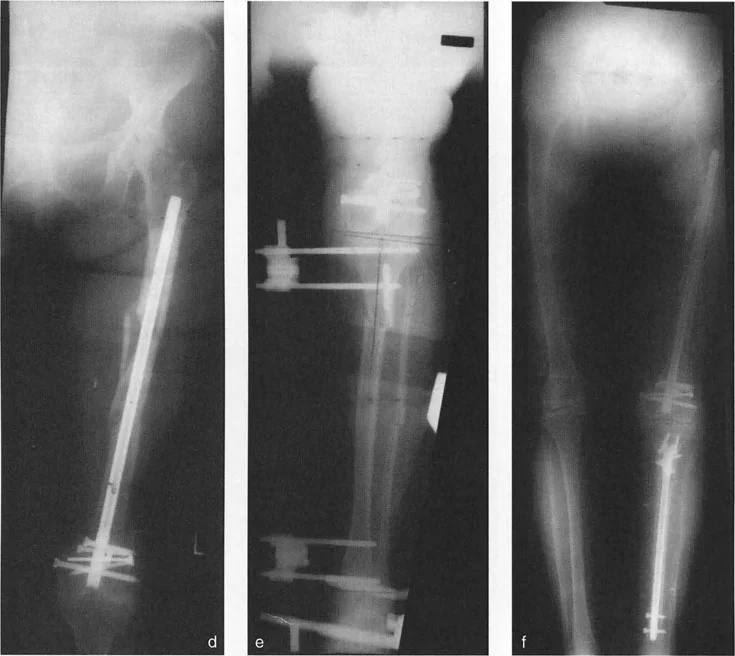 توضيح طبي: تصحيح تشوهات العظام وتطويلها: خبرة الأستاذ الدكتور محمد هطيف في صنعاء
