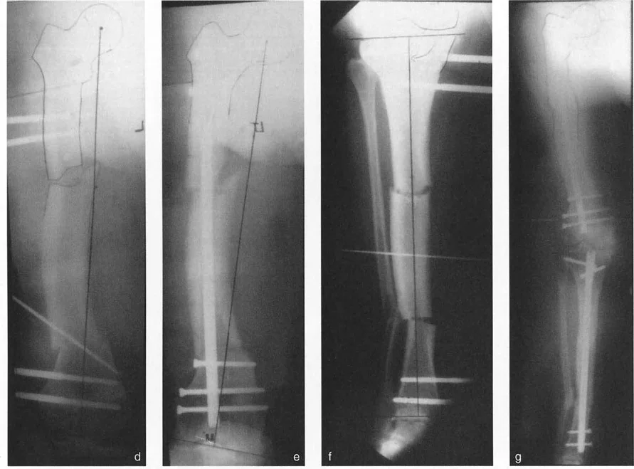 توضيح طبي: تصحيح تشوهات العظام وتطويلها: خبرة الأستاذ الدكتور محمد هطيف في صنعاء
