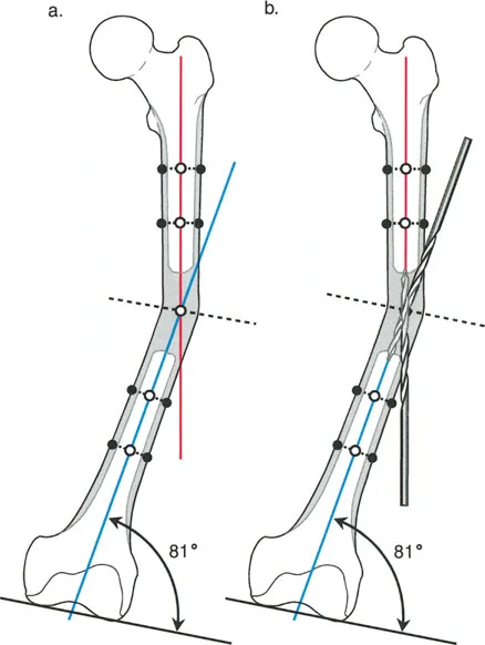 توضيح طبي: تصحيح تشوهات العظام وتطويلها: خبرة الأستاذ الدكتور محمد هطيف في صنعاء