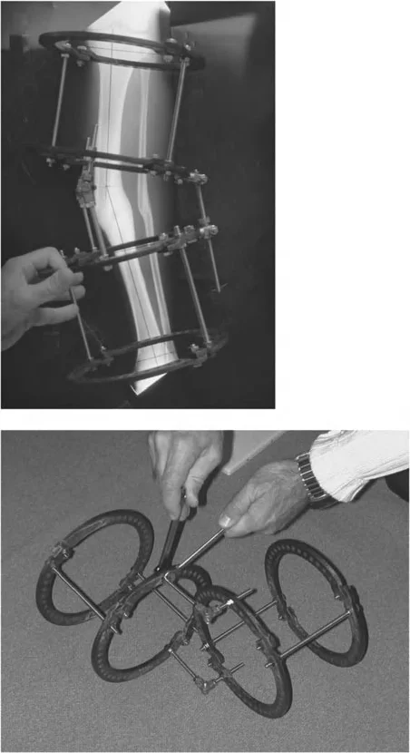 توضيح طبي: تصحيح تشوهات العظام وتطويلها: خبرة الأستاذ الدكتور محمد هطيف في صنعاء