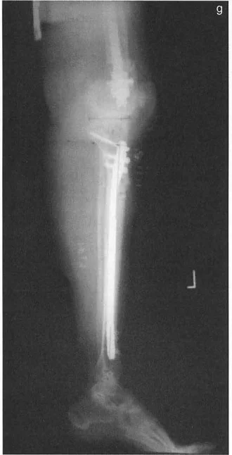 توضيح طبي: تصحيح تشوهات العظام وتطويلها: خبرة الأستاذ الدكتور محمد هطيف في صنعاء