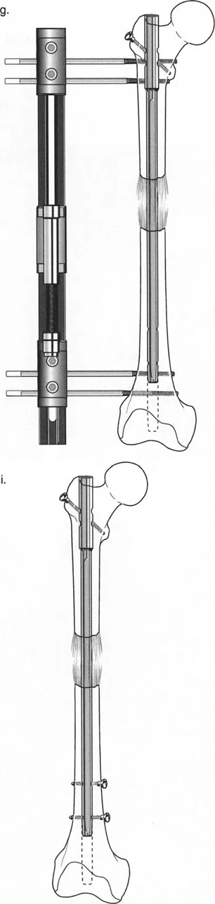 توضيح طبي: تصحيح تشوهات العظام وتطويلها: خبرة الأستاذ الدكتور محمد هطيف في صنعاء