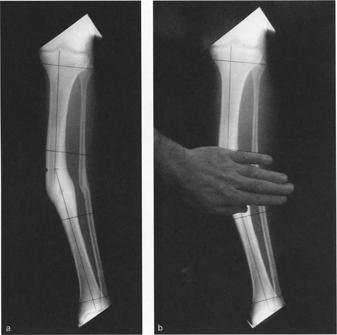 توضيح طبي: تصحيح تشوهات العظام وتطويلها: خبرة الأستاذ الدكتور محمد هطيف في صنعاء