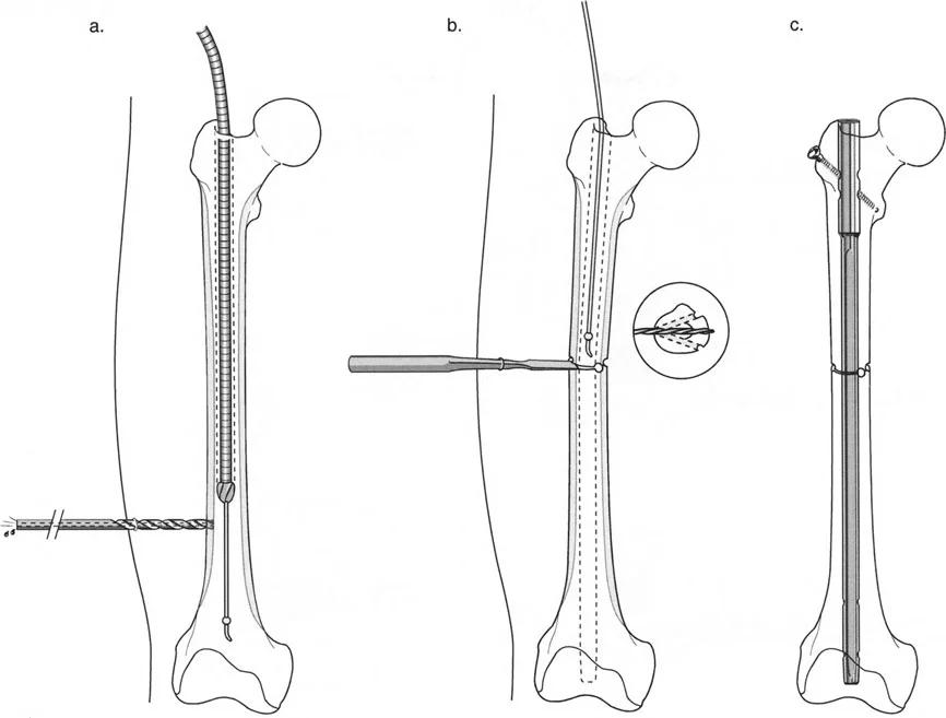 توضيح طبي: تصحيح تشوهات العظام وتطويلها: خبرة الأستاذ الدكتور محمد هطيف في صنعاء