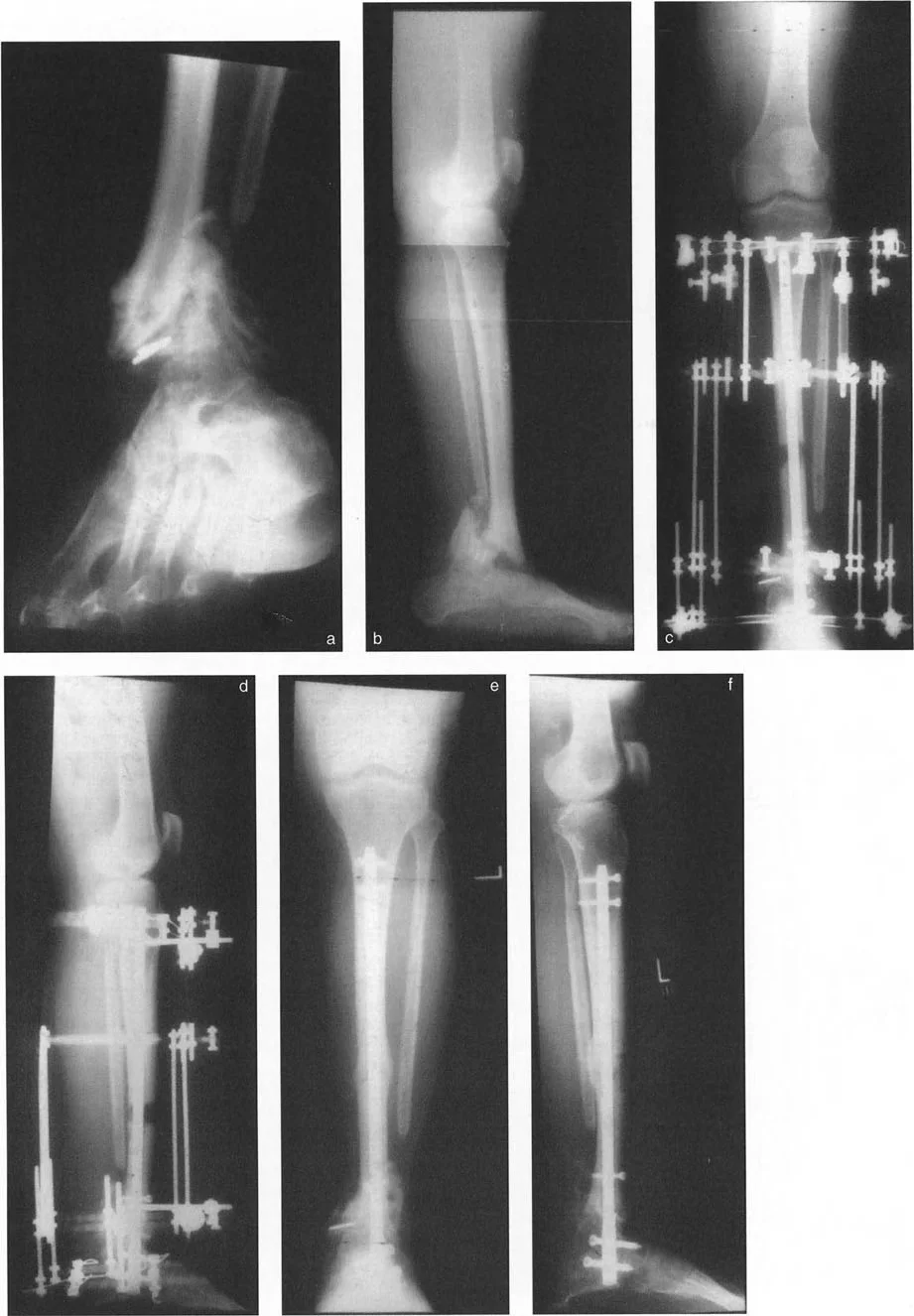 توضيح طبي: تصحيح تشوهات العظام وتطويلها: خبرة الأستاذ الدكتور محمد هطيف في صنعاء