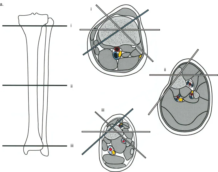 صورة توضيحية لـ إتقان مبادئ بالي: الدليل الشامل لأجهزة التثبيت الخارجية وجراحة العظم لتصحيح تشوهات الأطراف