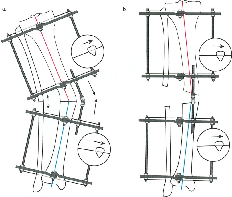 صورة طبية: إتقان مبادئ بالي: الدليل الشامل لأجهزة التثبيت الخارجية وجراحة العظم لتصحيح تشوهات الأطراف