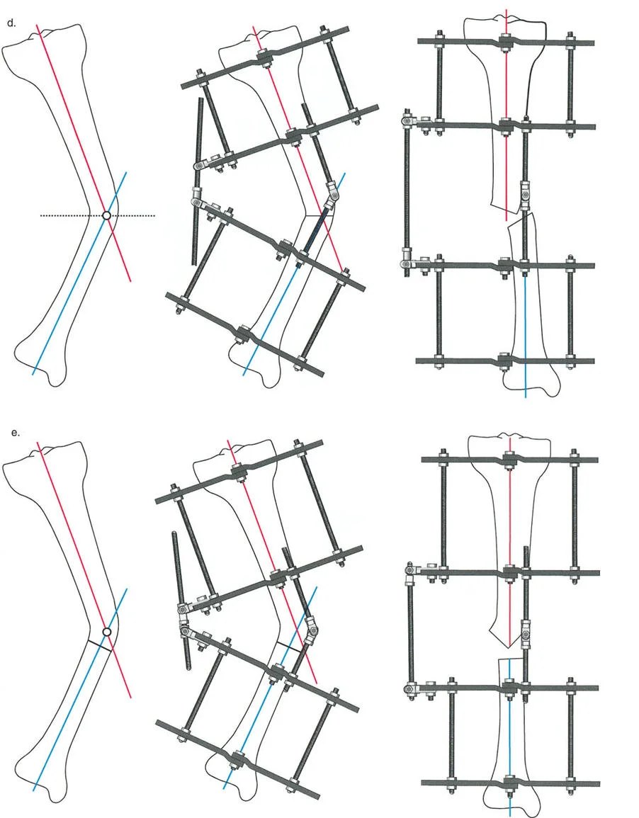 صورة توضيحية لـ إتقان مبادئ بالي: الدليل الشامل لأجهزة التثبيت الخارجية وجراحة العظم لتصحيح تشوهات الأطراف