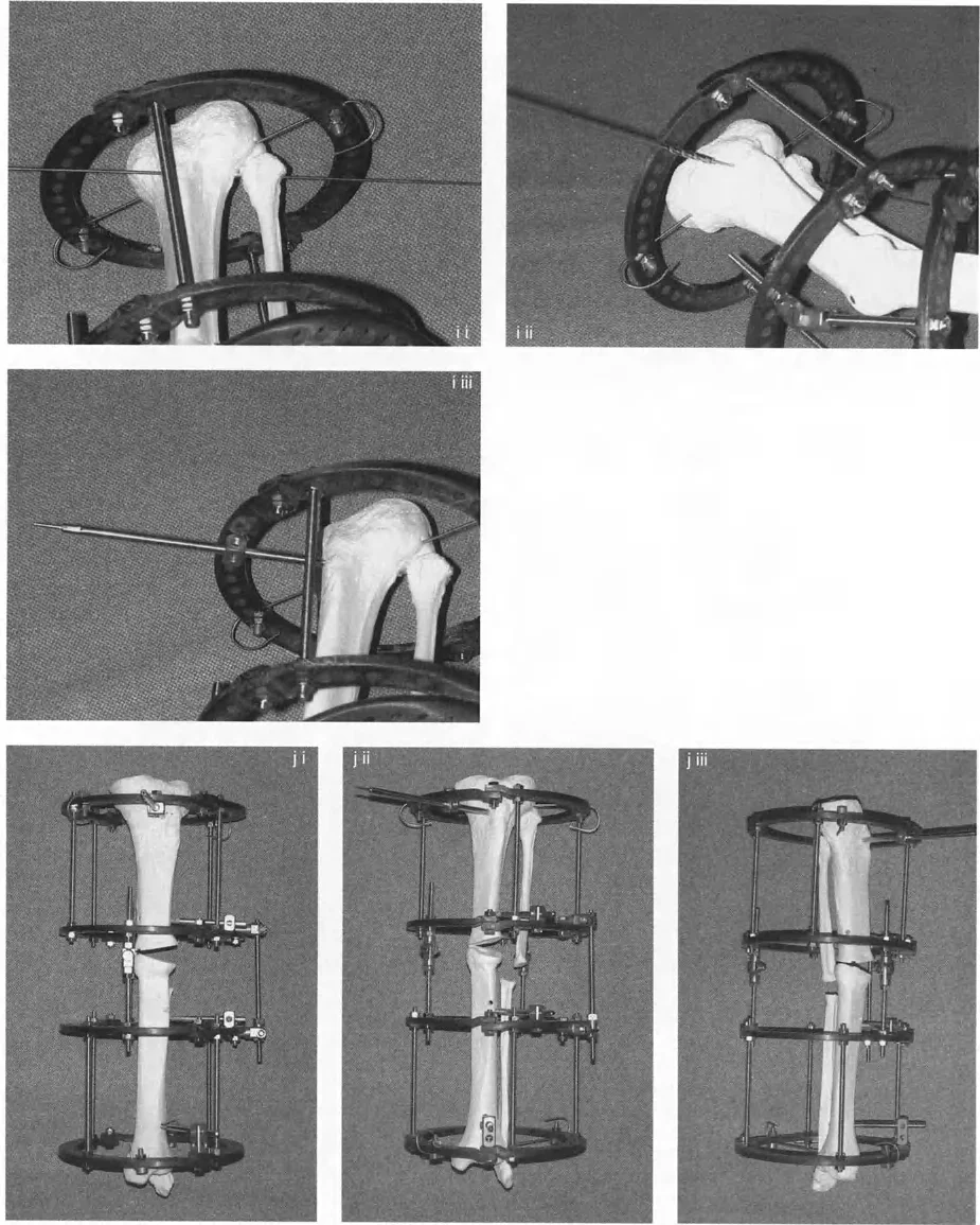 صورة طبية: إتقان مبادئ بالي: الدليل الشامل لأجهزة التثبيت الخارجية وجراحة العظم لتصحيح تشوهات الأطراف