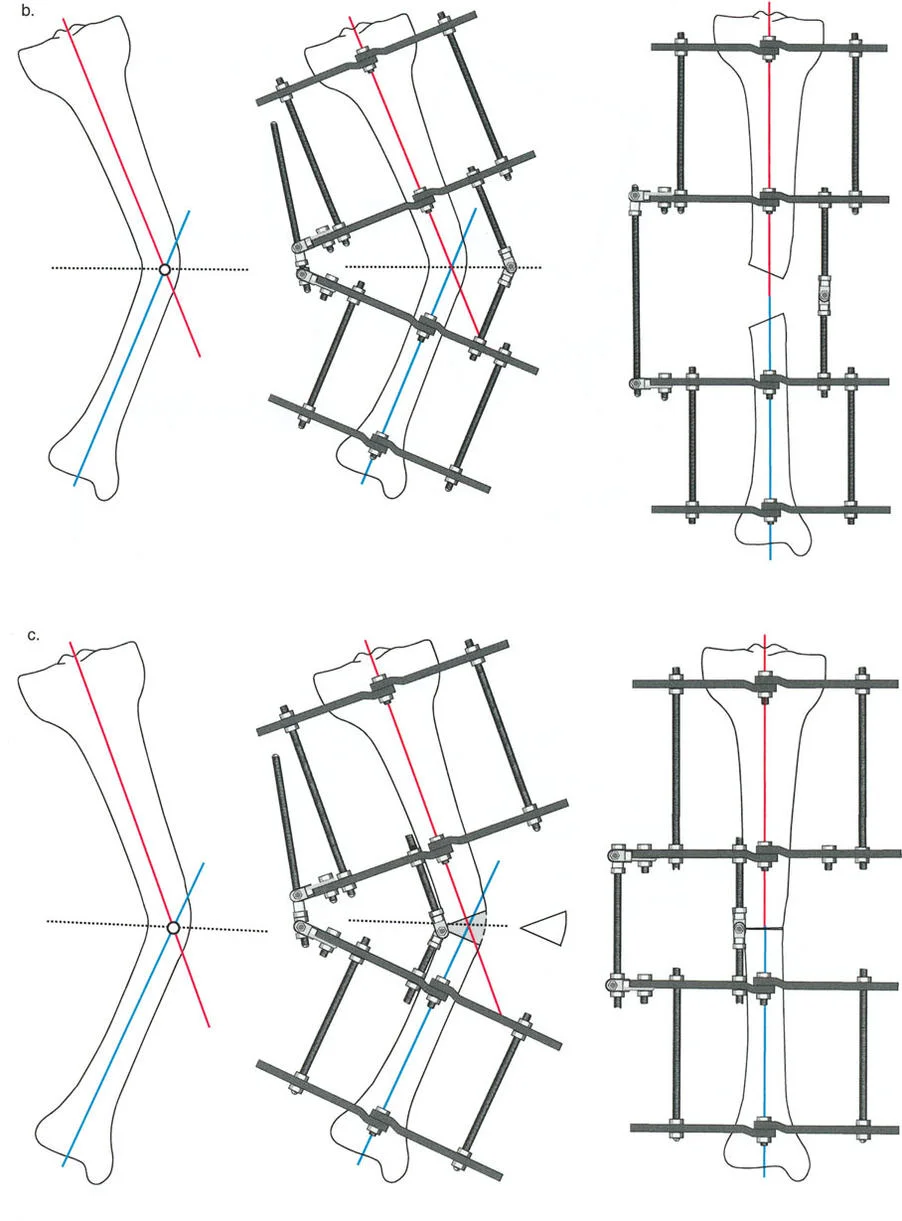 إتقان مبادئ بالي: الدليل الشامل لأجهزة التثبيت الخارجية وجراحة العظم لتصحيح تشوهات الأطراف