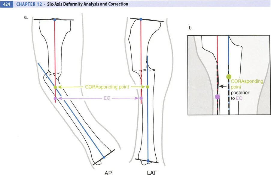 صورة طبية: تصحيح تشوهات العظام بتقنيات بالي المتقدمة الدليل الشامل للمرضى مع الأستاذ الدكتور محمد هطيف