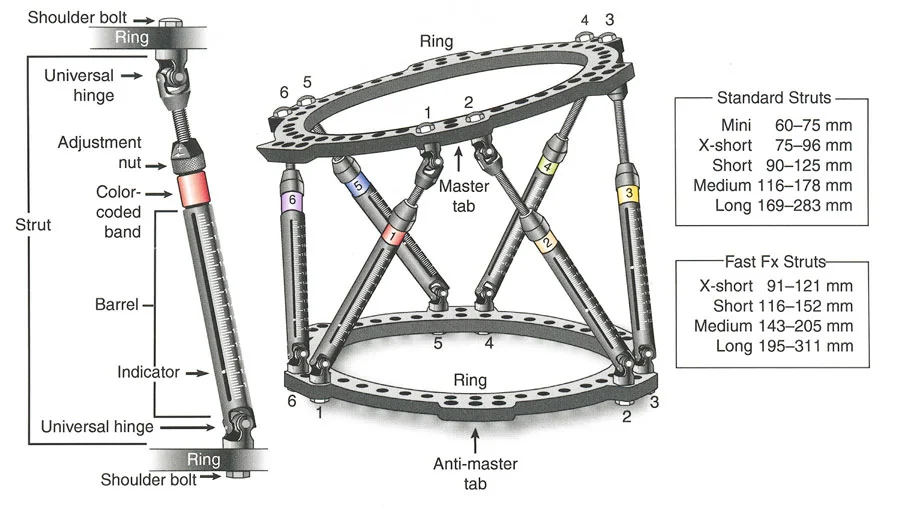 صورة طبية: تصحيح تشوهات العظام بتقنيات بالي المتقدمة الدليل الشامل للمرضى مع الأستاذ الدكتور محمد هطيف