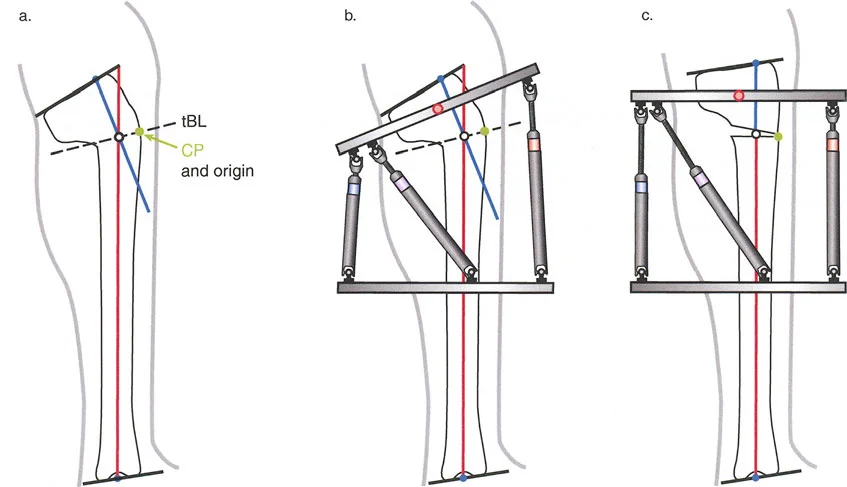 صورة طبية: تصحيح تشوهات العظام بتقنيات بالي المتقدمة الدليل الشامل للمرضى مع الأستاذ الدكتور محمد هطيف