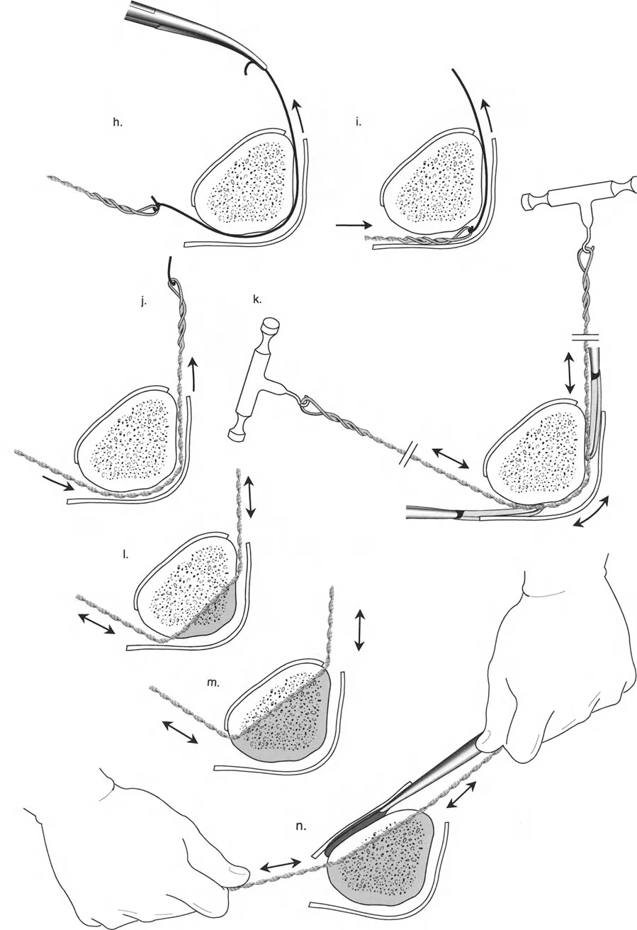 صورة طبية: تصحيح تشوهات العظام بتقنيات بالي المتقدمة الدليل الشامل للمرضى مع الأستاذ الدكتور محمد هطيف