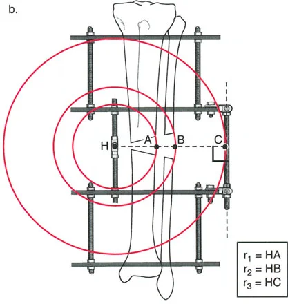 صورة طبية: تصحيح تشوهات العظام بتقنيات بالي المتقدمة الدليل الشامل للمرضى مع الأستاذ الدكتور محمد هطيف
