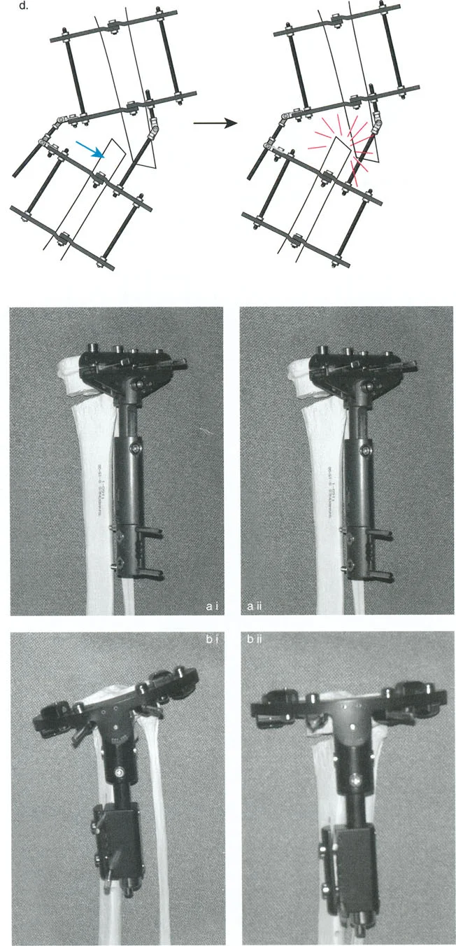صورة طبية: تصحيح تشوهات العظام بتقنيات بالي المتقدمة الدليل الشامل للمرضى مع الأستاذ الدكتور محمد هطيف