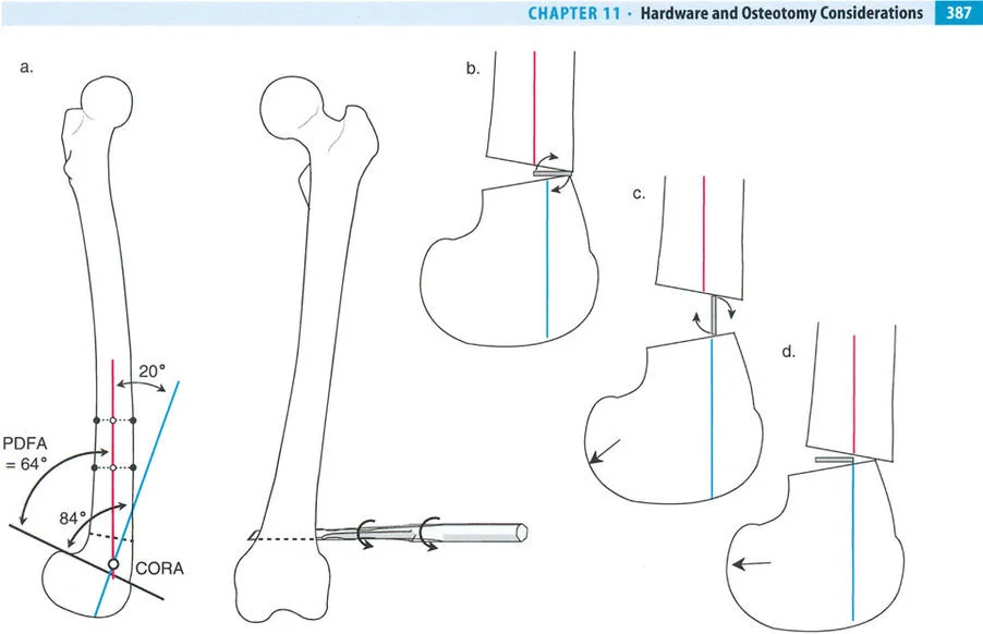 صورة توضيحية لتصحيح التشوهات العظمية