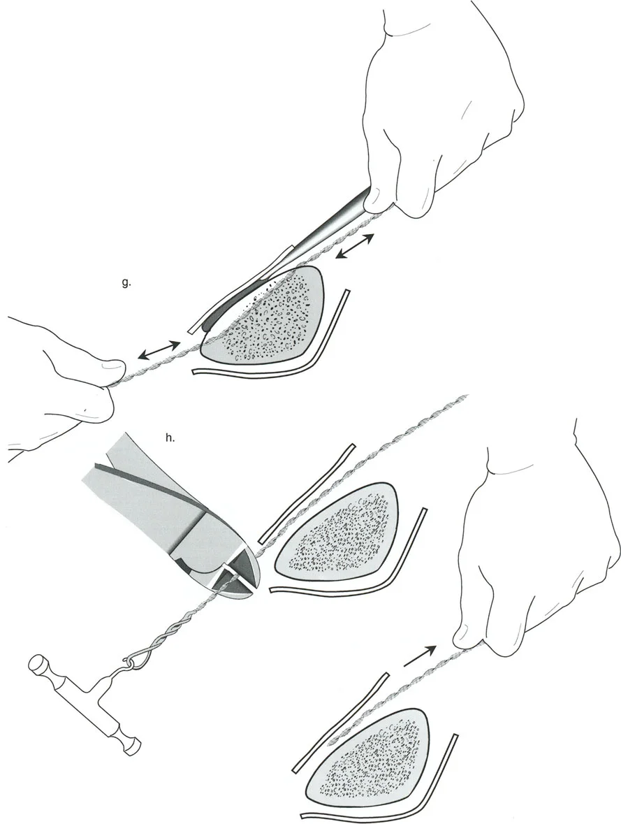 صورة طبية: تصحيح تشوهات العظام بتقنيات بالي المتقدمة الدليل الشامل للمرضى مع الأستاذ الدكتور محمد هطيف