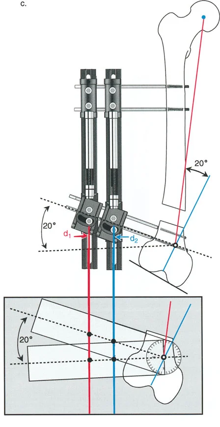صورة طبية: تصحيح تشوهات العظام بتقنيات بالي المتقدمة الدليل الشامل للمرضى مع الأستاذ الدكتور محمد هطيف