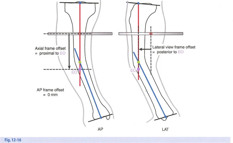 صورة توضيحية لـ تصحيح تشوهات العظام بتقنيات بالي المتقدمة الدليل الشامل للمرضى مع الأستاذ الدكتور محمد هطيف