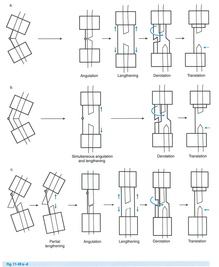 صورة طبية: تصحيح تشوهات العظام بتقنيات بالي المتقدمة الدليل الشامل للمرضى مع الأستاذ الدكتور محمد هطيف