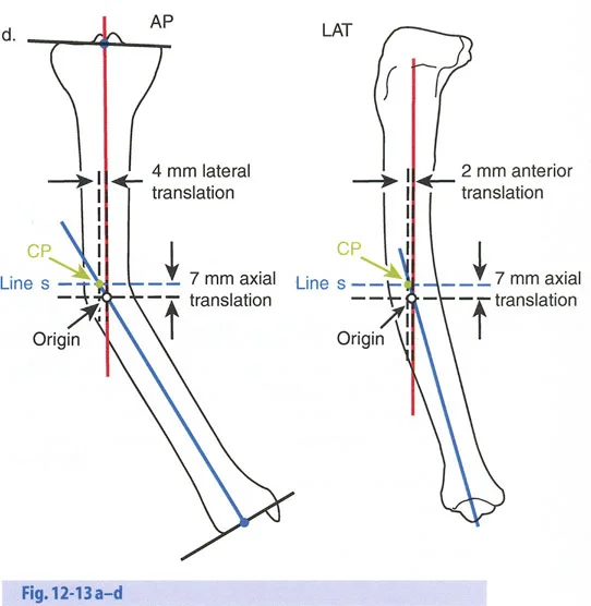 صورة توضيحية لـ تصحيح تشوهات العظام بتقنيات بالي المتقدمة الدليل الشامل للمرضى مع الأستاذ الدكتور محمد هطيف