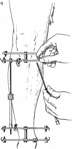صورة توضيحية للمبدأ البيولوجي لتوليد العظم بالشد