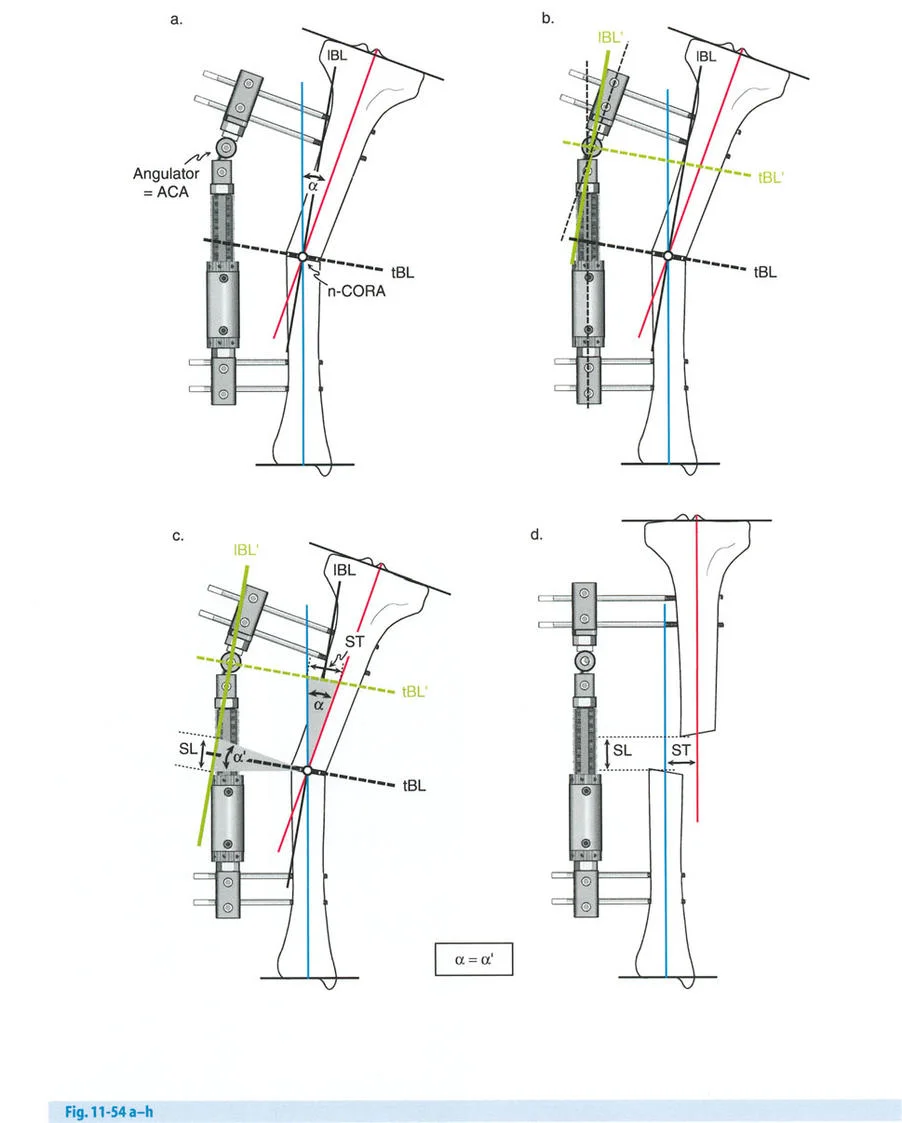صورة طبية: تصحيح تشوهات العظام بتقنيات بالي المتقدمة الدليل الشامل للمرضى مع الأستاذ الدكتور محمد هطيف