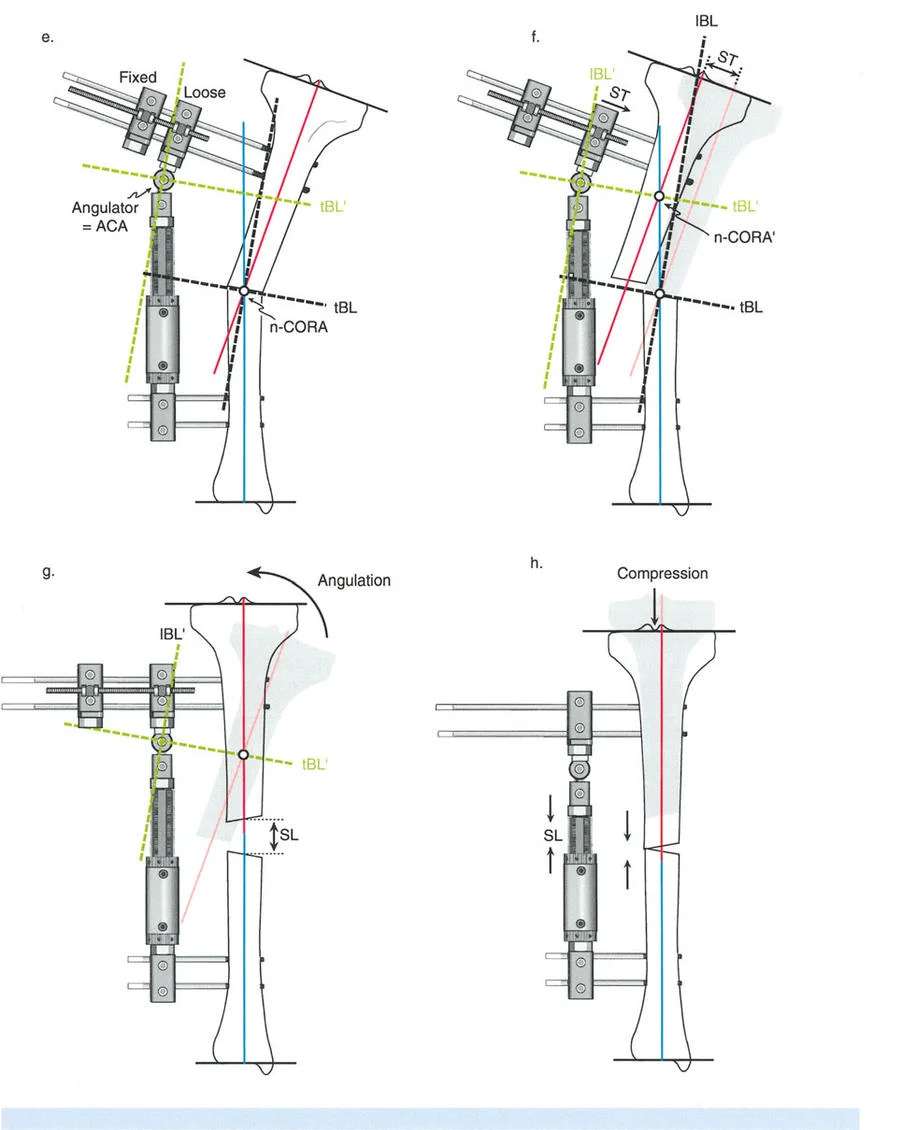 صورة طبية: تصحيح تشوهات العظام بتقنيات بالي المتقدمة الدليل الشامل للمرضى مع الأستاذ الدكتور محمد هطيف
