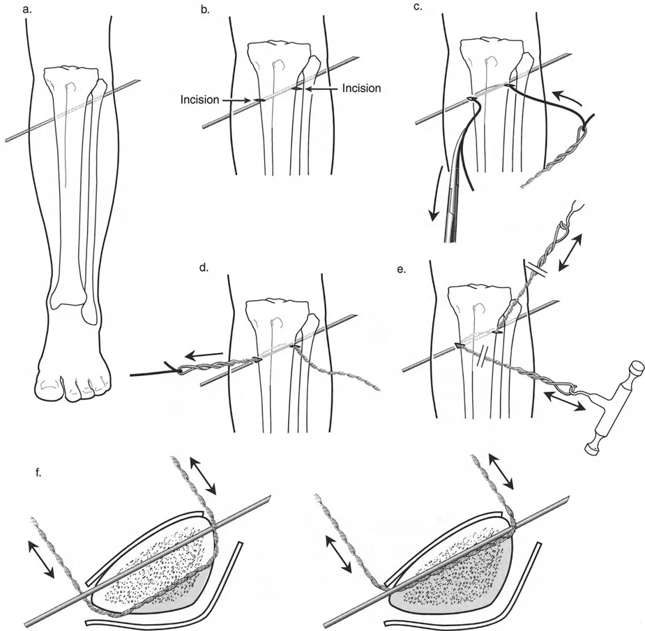صورة طبية: تصحيح تشوهات العظام بتقنيات بالي المتقدمة الدليل الشامل للمرضى مع الأستاذ الدكتور محمد هطيف