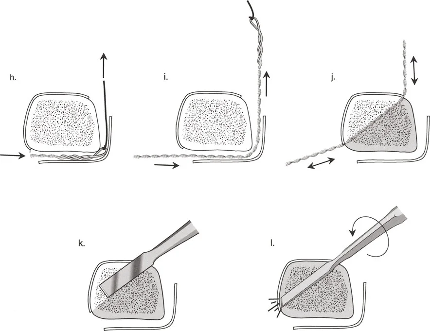 صورة طبية: تصحيح تشوهات العظام بتقنيات بالي المتقدمة الدليل الشامل للمرضى مع الأستاذ الدكتور محمد هطيف