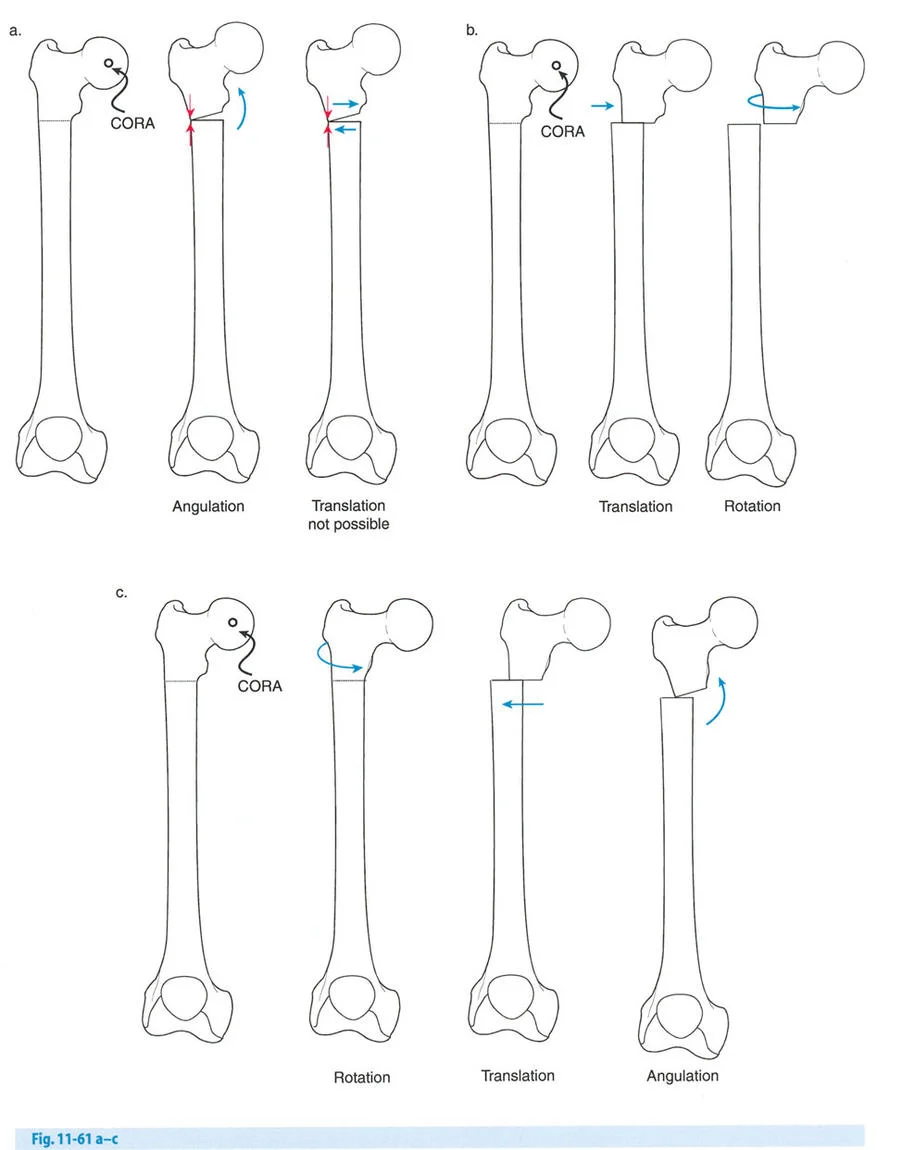صورة توضيحية لـ تصحيح تشوهات العظام بتقنيات بالي المتقدمة الدليل الشامل للمرضى مع الأستاذ الدكتور محمد هطيف