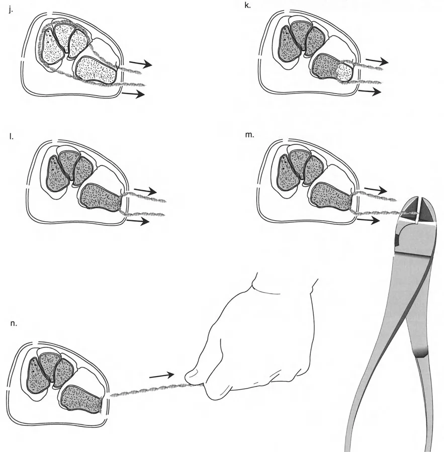 صورة طبية: تصحيح تشوهات العظام بتقنيات بالي المتقدمة الدليل الشامل للمرضى مع الأستاذ الدكتور محمد هطيف