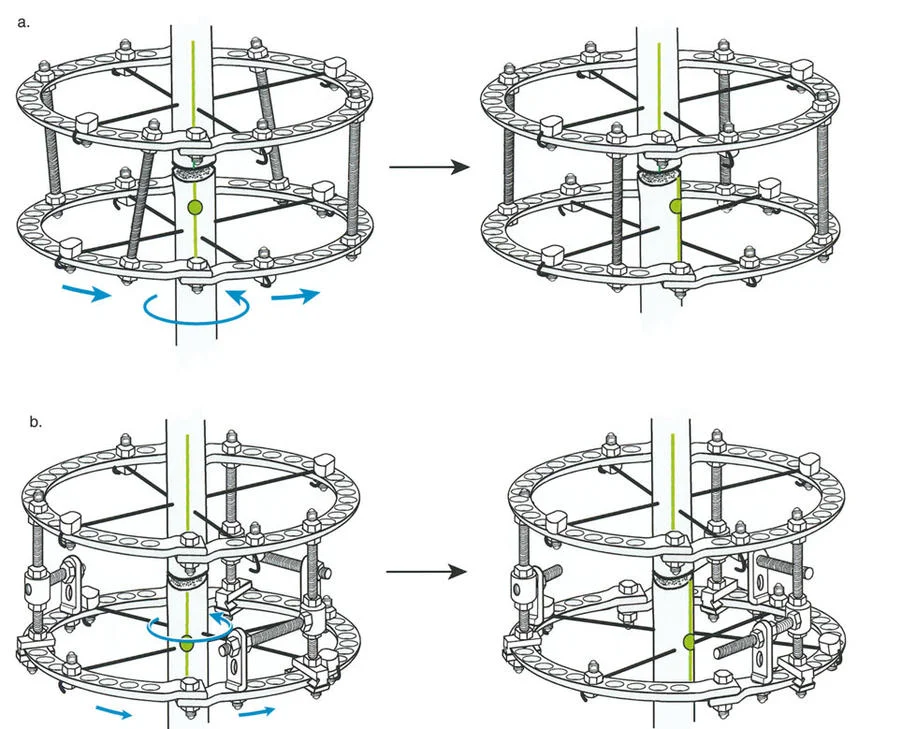 صورة توضيحية لأسلاك الزيتون المعاكسة