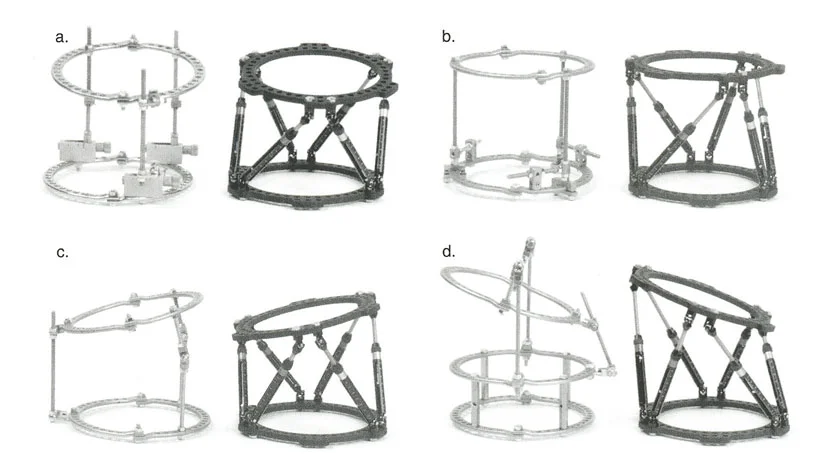 صورة طبية: تصحيح تشوهات العظام بتقنيات بالي المتقدمة الدليل الشامل للمرضى مع الأستاذ الدكتور محمد هطيف