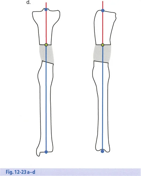 صورة طبية: تصحيح تشوهات العظام بتقنيات بالي المتقدمة الدليل الشامل للمرضى مع الأستاذ الدكتور محمد هطيف