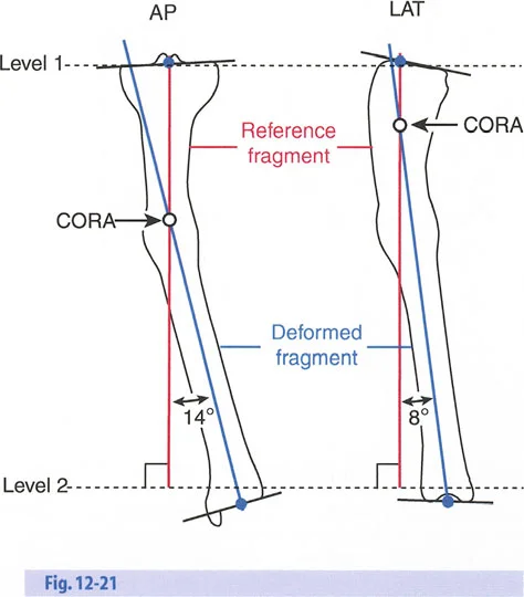 صورة طبية: تصحيح تشوهات العظام بتقنيات بالي المتقدمة الدليل الشامل للمرضى مع الأستاذ الدكتور محمد هطيف