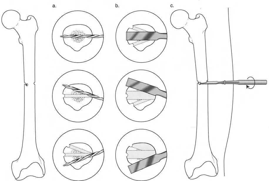 صورة طبية: تصحيح تشوهات العظام بتقنيات بالي المتقدمة الدليل الشامل للمرضى مع الأستاذ الدكتور محمد هطيف