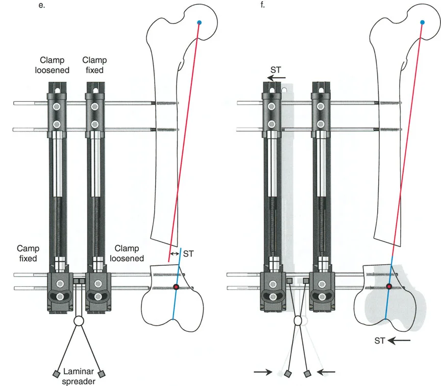 صورة طبية: تصحيح تشوهات العظام بتقنيات بالي المتقدمة الدليل الشامل للمرضى مع الأستاذ الدكتور محمد هطيف